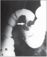 Obstrução Intestinal